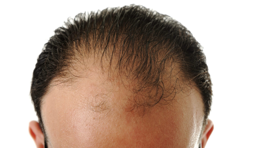 mens hairline solutions norwalk CT